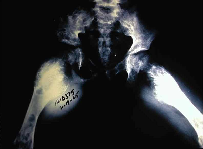 http://img.orthobullets.com/Pathology/Chondrogenic%20Lesions/Chondromas/Enchondromas/Images/Olliers%20-%20xray%20-%20pelvis.jpg