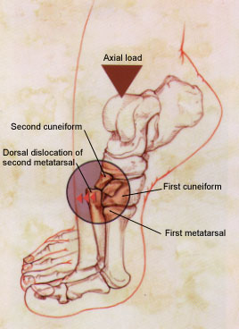 Lisfranc Injury - Foot & Ankle - Orthobullets contusion wound diagram 