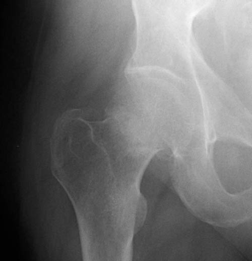 femoral neck pathological fracture icd 10